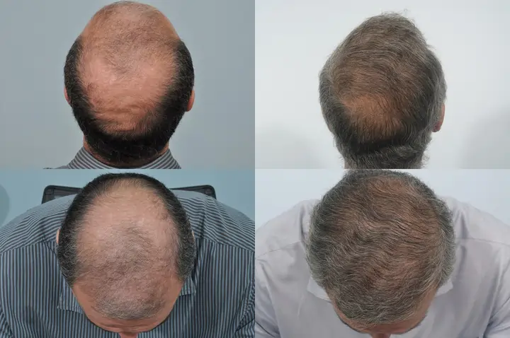 Hair Transplant After 10 Years