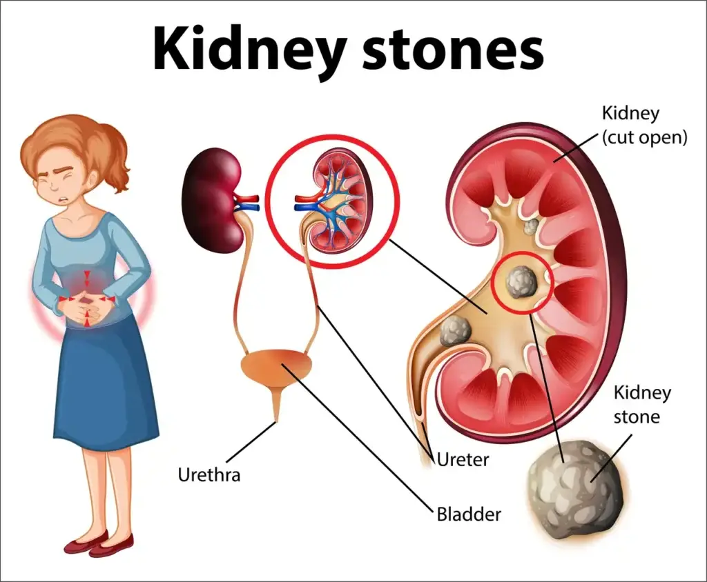 Vitamin K and Kidney Stones